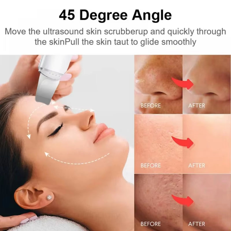 Ultrasonic Skin Care Spatula with Vibration for Blackhead Removal and Facial Exfoliation